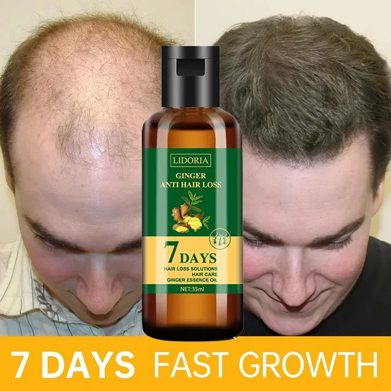 Hair Care Essential Oil Atomizing - Ingwer Haarwuchs ätherisches Öl Anti-Verlust Haarwuchs