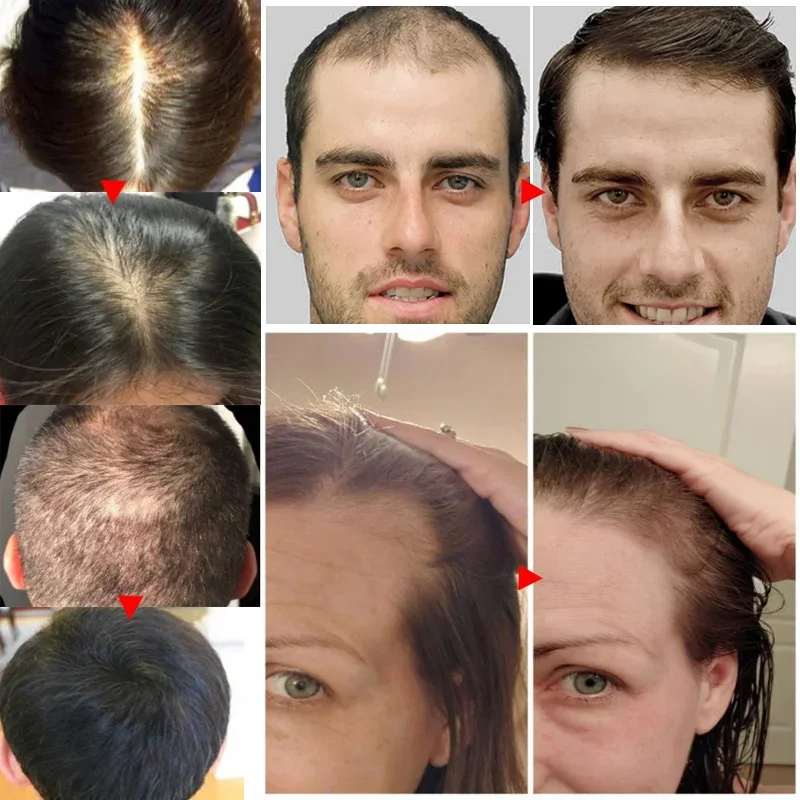 Ingwer Haarwuchs ätherisches Ö – Hair Care Essential Oil Atomizing Bewertung und Preis